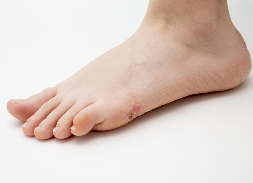 6個“錦囊”防護糖尿病足